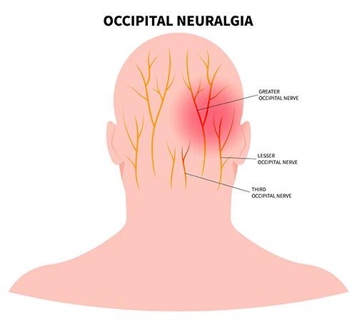 treating-occipital-neuralgia-our-focused-condition-of-the-month